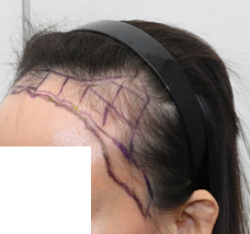 수술 전 디자인