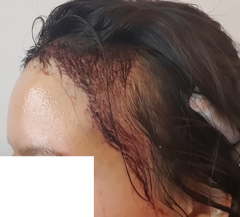 수술 직후 모습