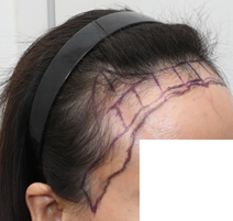 수술 전 디자인