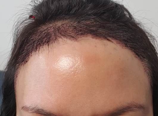 수술 3일차 첫 샴푸 모습
