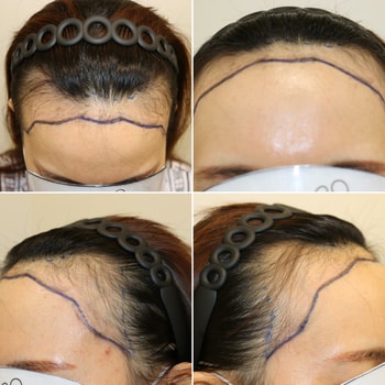 수술전 그려주신 사진