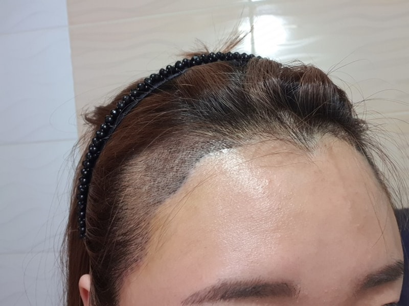 수술 6일후.jpg