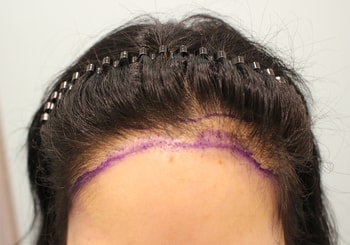 흉터 주변으로 감추는 모발이식 받았어요