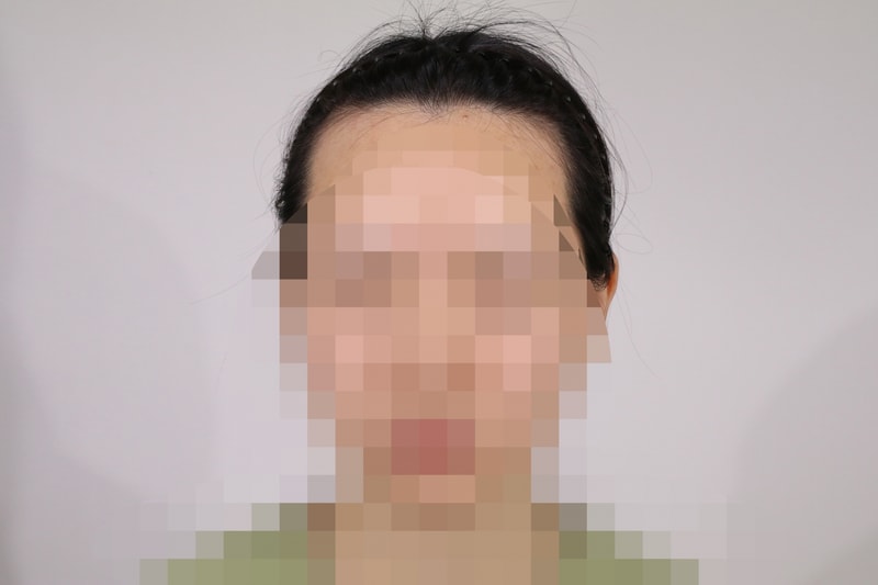 狎鸥亭站毛雨林医院切开女性发际线2500头(服务共3700头)