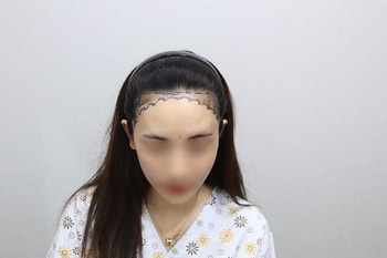 수술 전 디자인