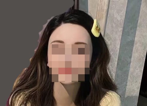 헤어라인 4년차