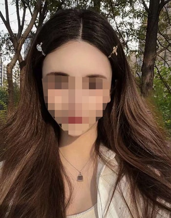 헤어라인 4년차
