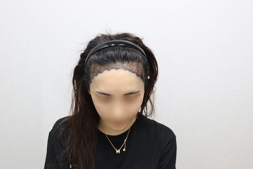 수술 다음날