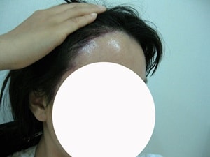 수술후 모습이에요. 절개 2300모 한거랍니다.