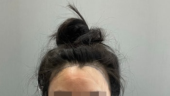 채취 끝나고 회복실에서 찍은거에용