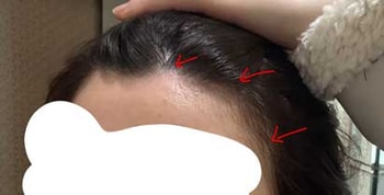  튀어나와보여서 얼굴 더커보이고 고민이었던 부분