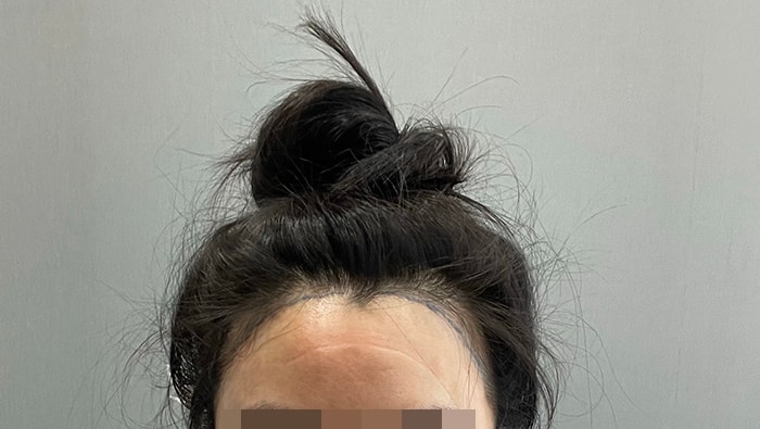 채취 끝나고 회복실에서 찍은거예용