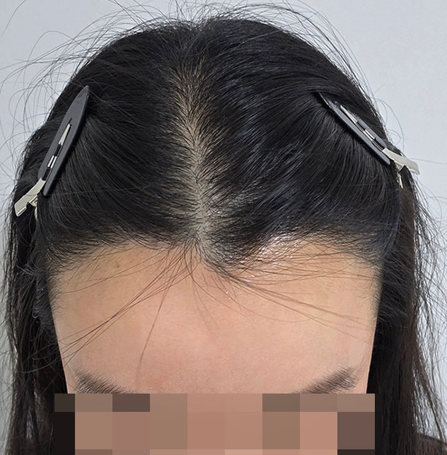 자연스럽게 이식돼서 티도 안나고 너무 좋습니당