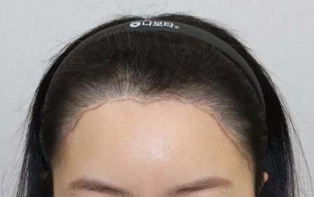 이식 전