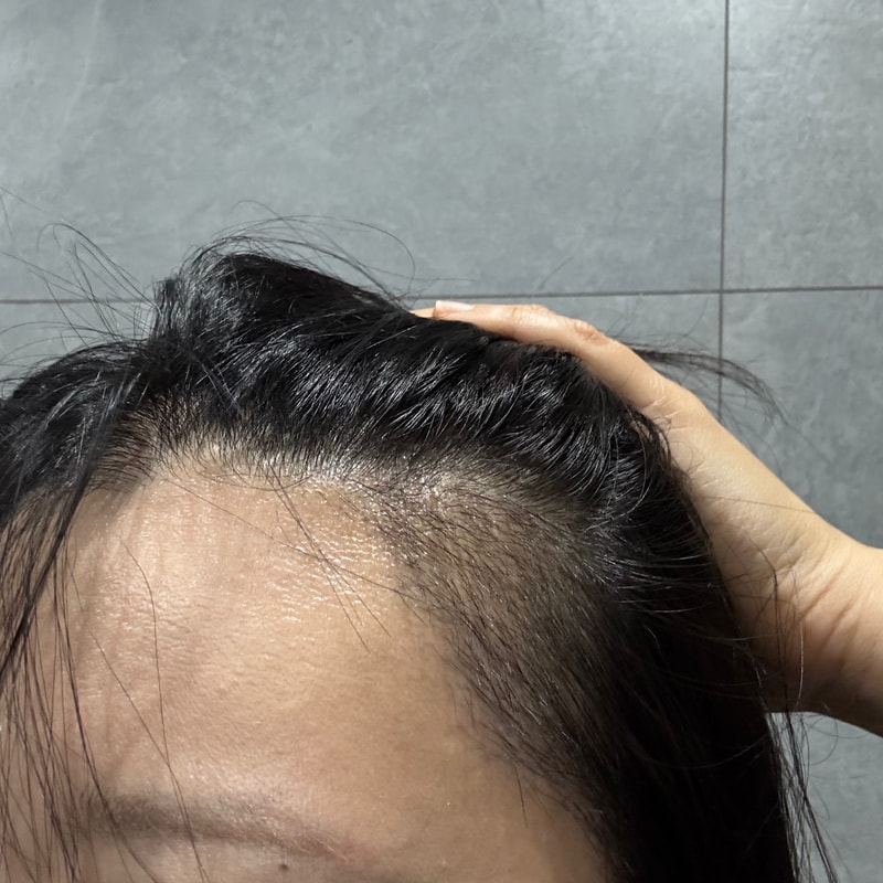 狎鸥亭毛雨林医院切开后记。