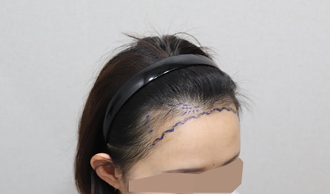 수술전-디자인 후