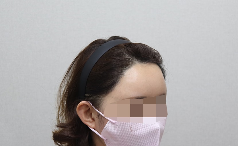 3년5개월 경과 사진-측면
