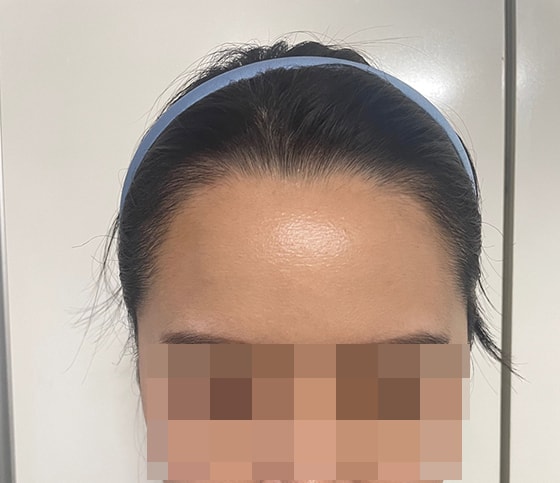 3개월 경과 (어제 찍은 사진이에용)