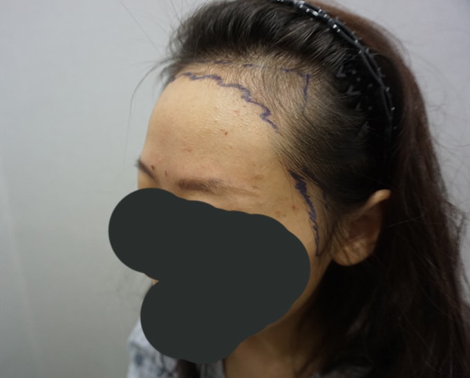 수술전