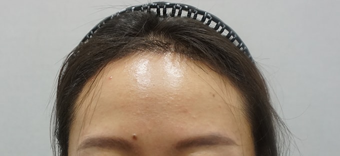 13일차 실밥제거일 촬영 