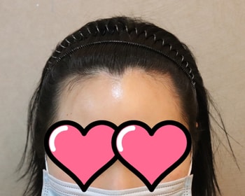 수술전