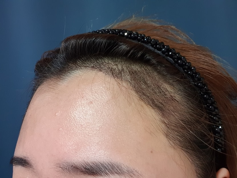 수술후 7일 왼쪽