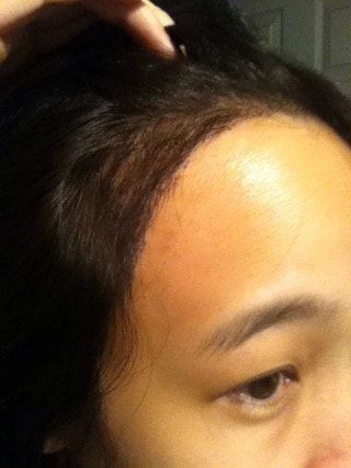 헤어라인 교정하고 8일째^^ 일주일진하고서도 이식부위는 깔끔했어요.ㅎ