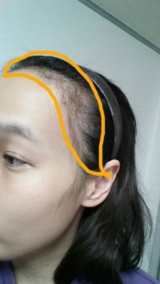 현재는 헤어라인하고 난 뒤 2개월이에요. 이사진은 일주일전쯤에 찍은건데. 이식모가 많이 빠졌죠^^