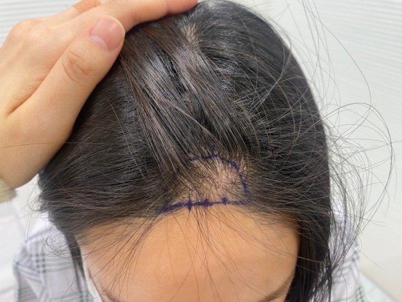 수술 전 디자인 