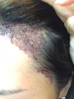 수술직후 양쪽 사진입니다