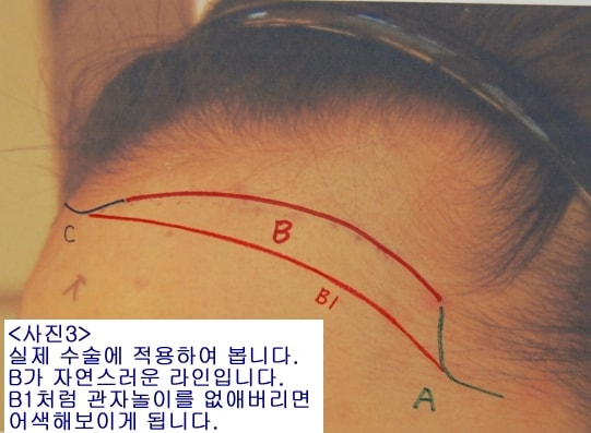 &lt;사진3&gt;- 여성헤어라인 이식 디자인의 실례