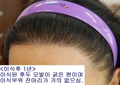 &lt;사진5&gt;- 위 환자분의 이식 1년 후 완성모습