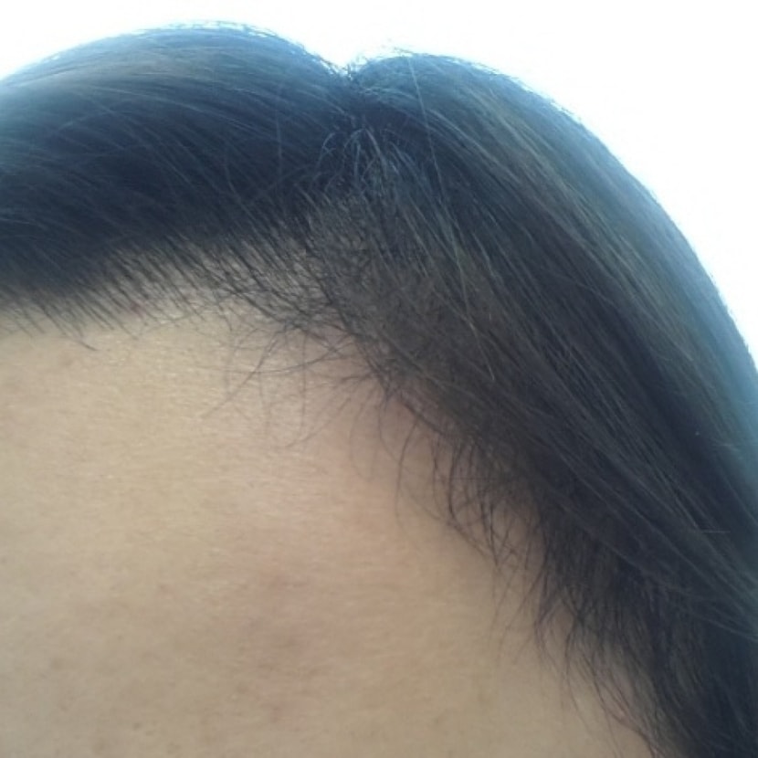 헤어라인 세달 반 후 (지금)