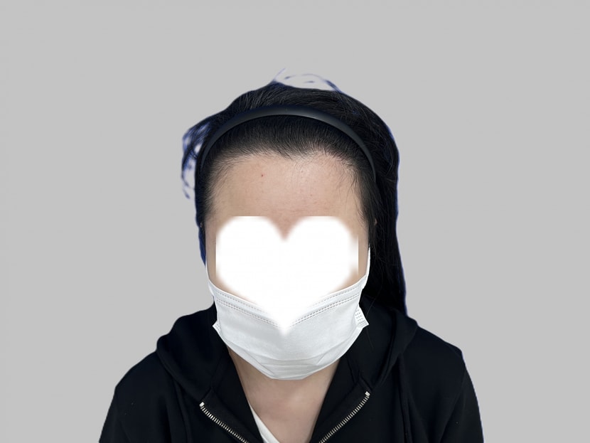 이게 이식 전 사진이에요 이마가 많이 넓었음