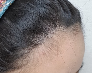 1년 경과한 모습 2