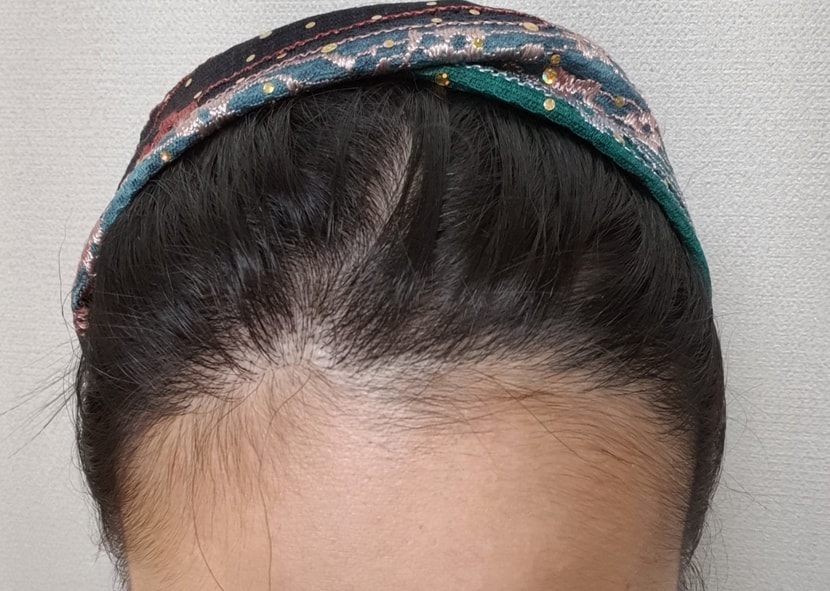 1년 경과한 모습 