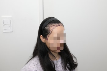 수술 전
