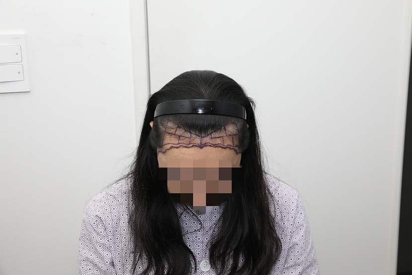 수술 전