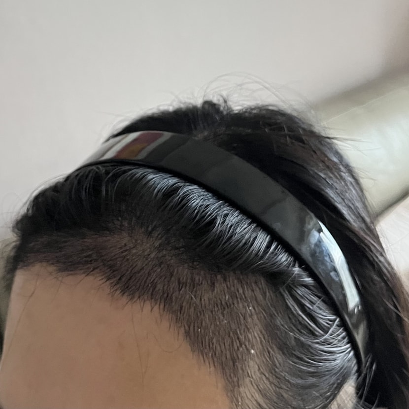 수술 후