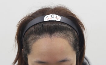 수술 후