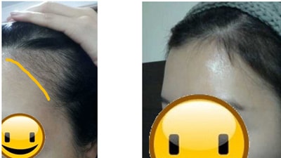 왼쪽2개월째, 오른쪽 5개월째(지금)