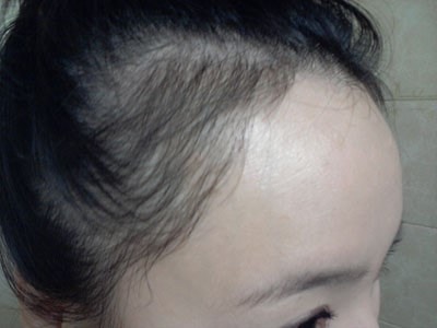 헤어라인 150일째