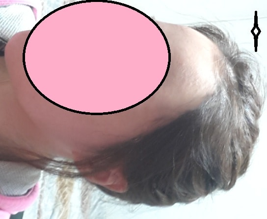 9개월째 최근 사진이에요 ㅎ문신했던게 남아서인지 밀도가 더 높아보여요 ㅋ