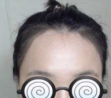 헤어라인 150일째