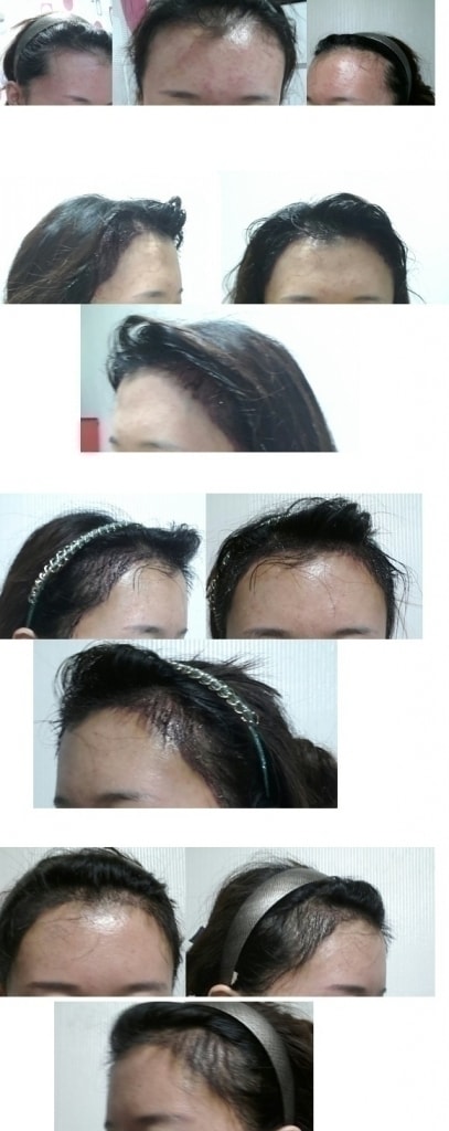 1. 수술전 당일 2. 수술후 당일 3.수술 다음날 4. 수술 10일째