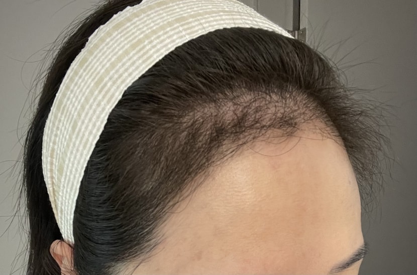 (((이식3개월차사진입니다)))