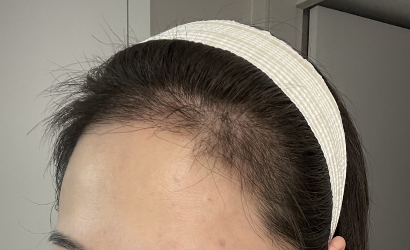 ((이식3개월차사진입니다))