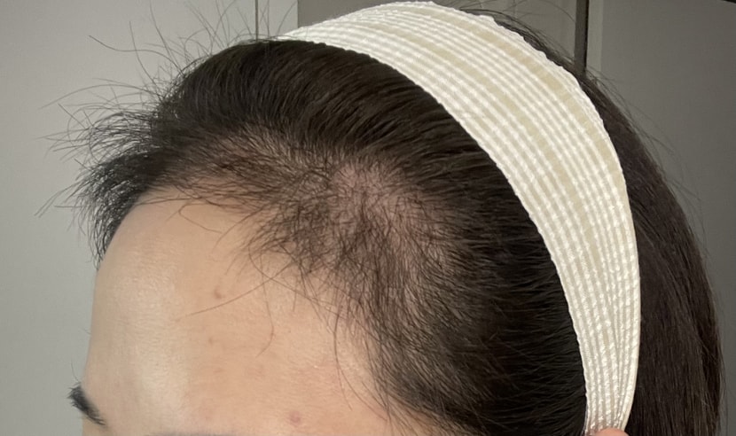 ((이식3개월차사진입니다))