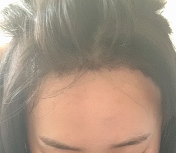 헤어라인 이식 후 1