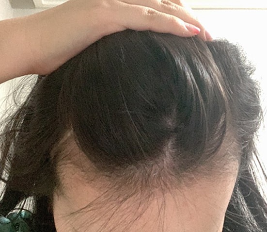 헤어라인 이식 전 1
